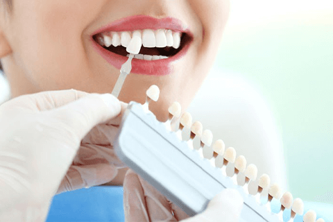 深圳牙貼面介紹