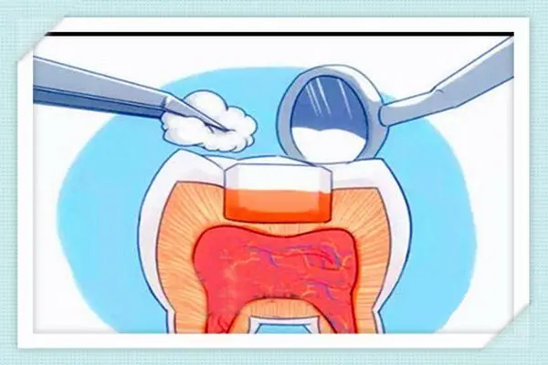 補牙的材料哪些比較實用？