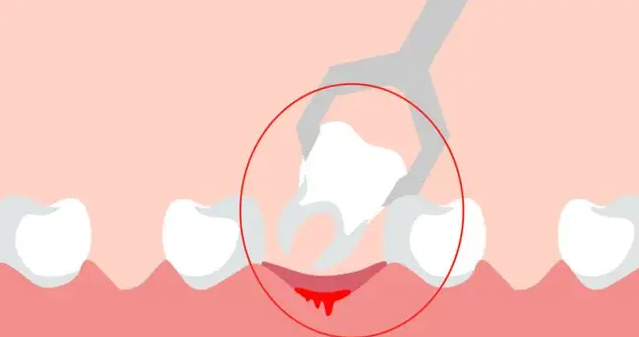 支招-如何處理拔牙後的疼痛和感染