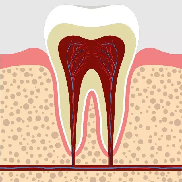 智齒碰上急性牙髓炎，直接剝除還是開髓後再剝除？