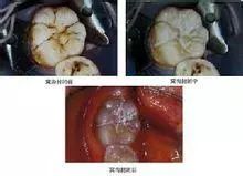 做牙咀封閉痛唔痛架？幾錢？做家長嘅應該要預先知道啲嘢