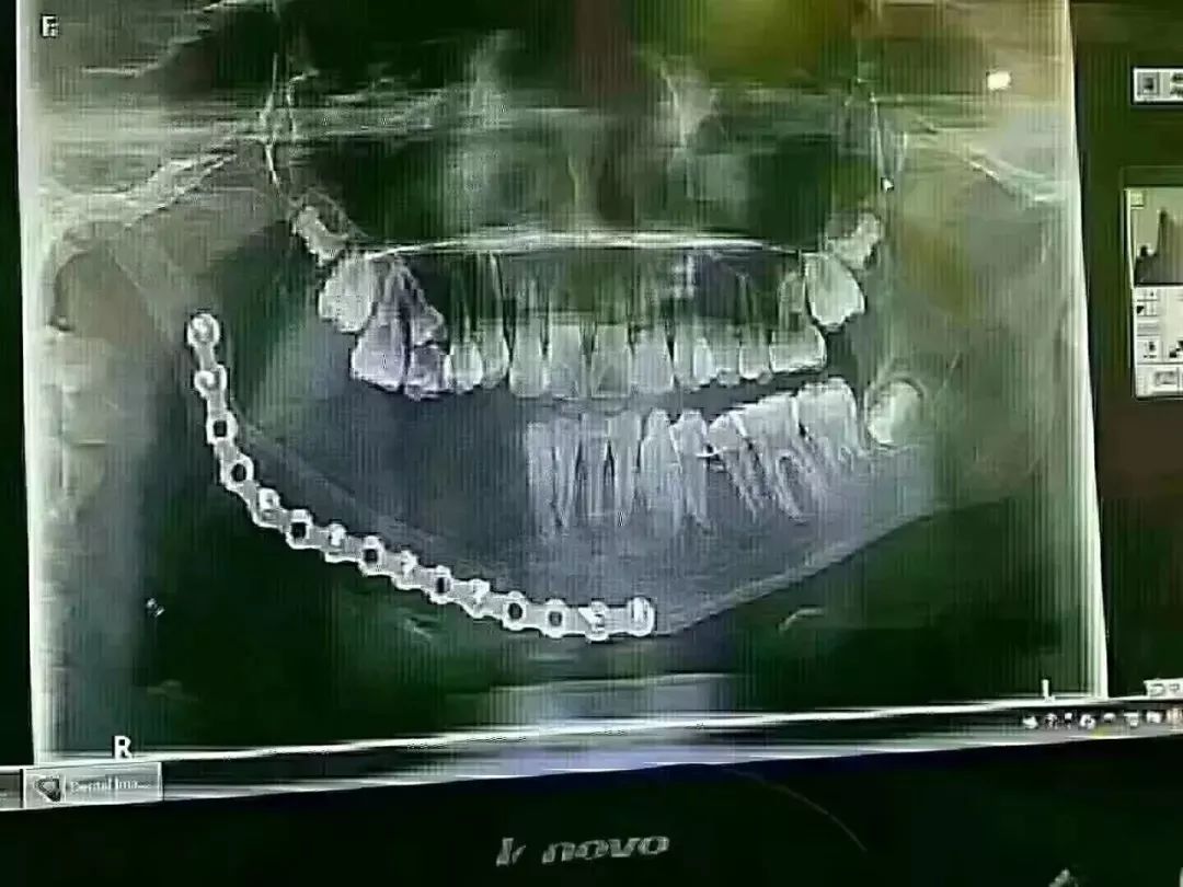 令人心痛！乳牙壞了不管，珠海12歲小姑娘最終花了16萬來切除下颌骨！
