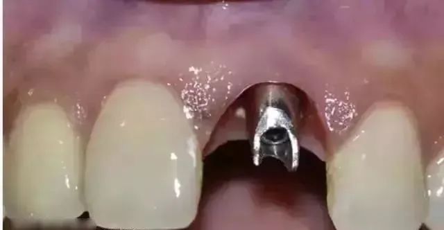 種植牙戴牙難度同戴入流程