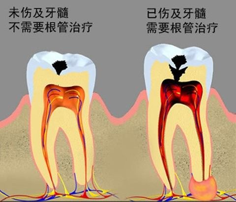 點解有時牙齒表面只有一個小洞，卻需要治療牙神經？