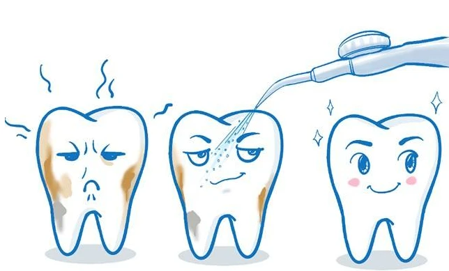 洗牙好唔好，4種洗牙方式你適合邊種？