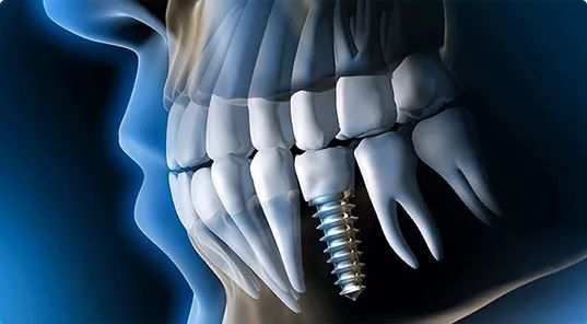 醫保局官宣種植牙集采“方案成熟”，專家話貴嘅係“服務費用”