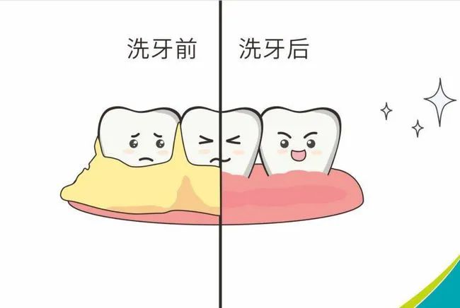 关于洗牙嘅谣言！