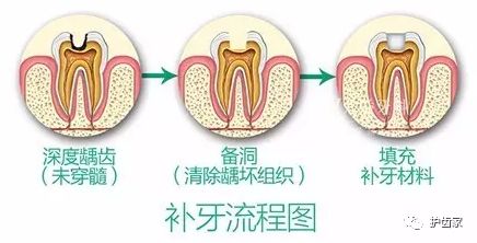 補牙後牙痛。。。呢個正常嗎?