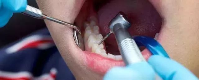 醫生，你講嘅填牙，點解變咗“鑽”牙？