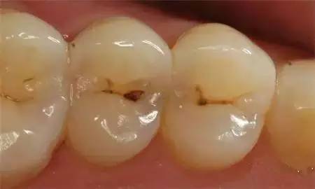 從蛀牙到剝牙，你珍惜你的牙齒了嗎？