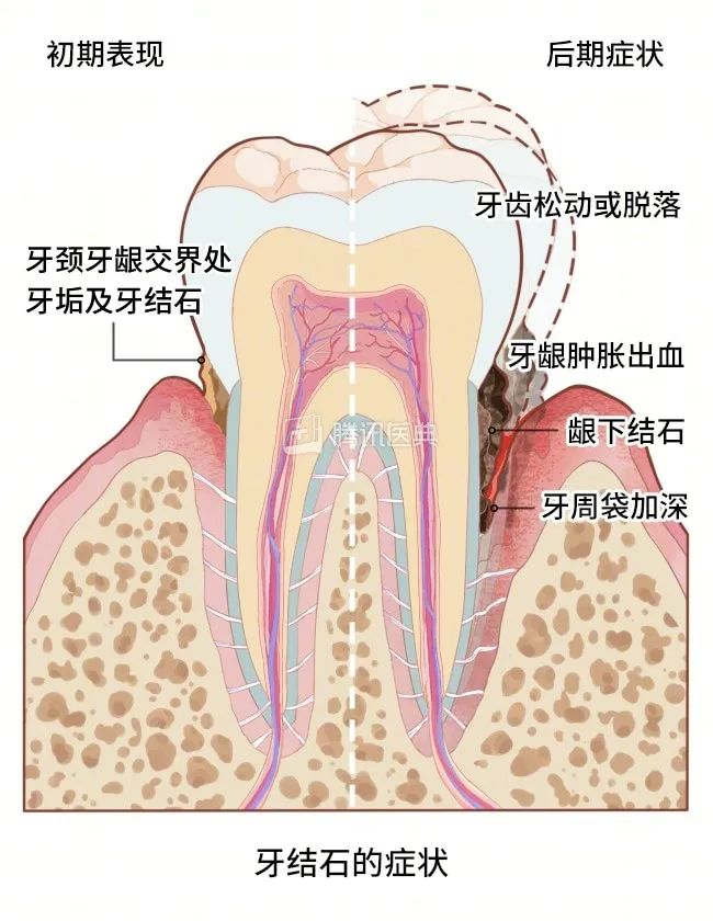 洗牙，牙結石嘅終結者