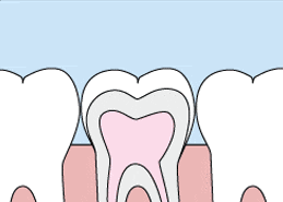 “犧牲”一隻牙令你睇明白，窩溝封閉係點樣預防蛀牙嘅