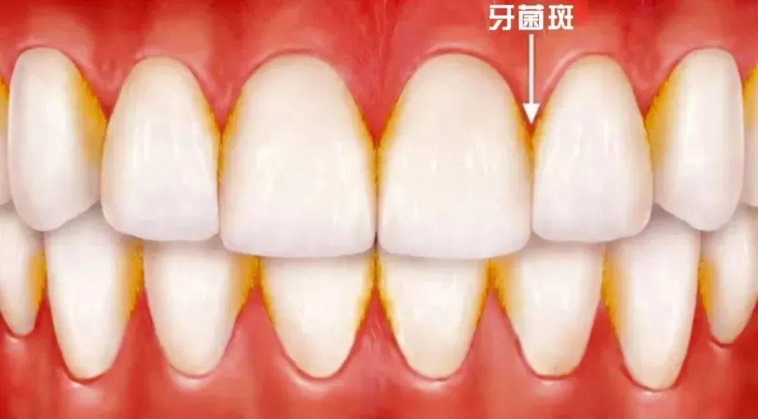 牙齦炎同牙周炎只有一字之差，區別竟然咁大！