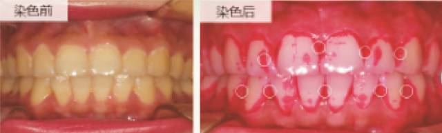 第一個值得細路仔懷念嘅可能就係離開嘅小乳牙，點樣先可以保護好口入邊嘅乳牙呀？