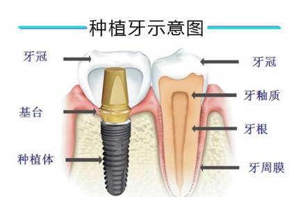 春暖花開，種牙得牙