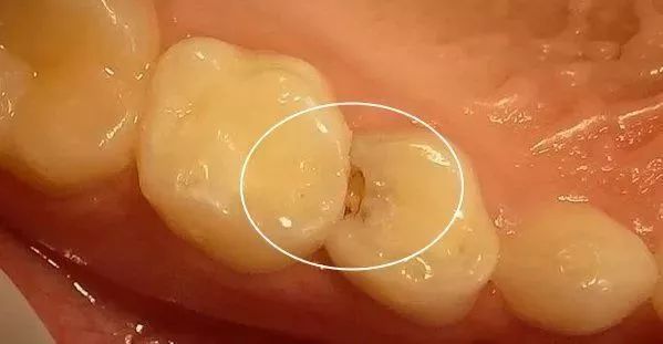一顆蛀牙被【牙醫拯救】嘅過程（多圖，易懂）
