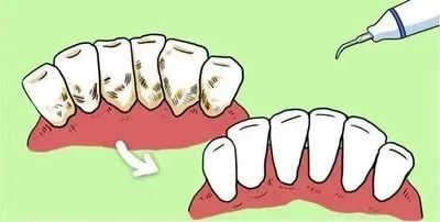 洗牙有咩嘢好處？爲什麼醫生都建議定期洗牙？