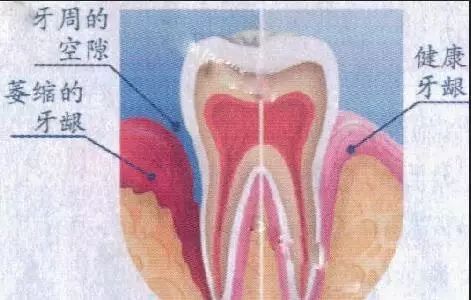 牙齒睇上去變長咗？原來係牙齦萎縮！
