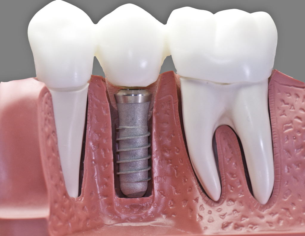 根管治療后牙齒又裂開了，還能修復嗎？