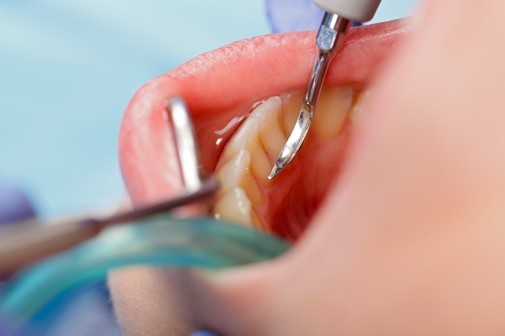 牙周炎”可以嚴重到什麼“程度？看完好“可怕