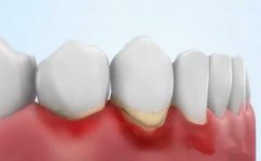 引起牙周炎的最主要原因？口腔科對牙周炎成因