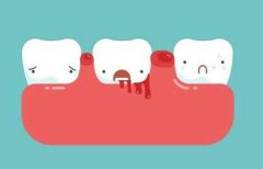 謹記牙齦出血的原因 須知牙齦出血暗藏大隱患