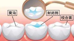 窩溝封閉全集：到底要不要給孩子做窩溝封閉？