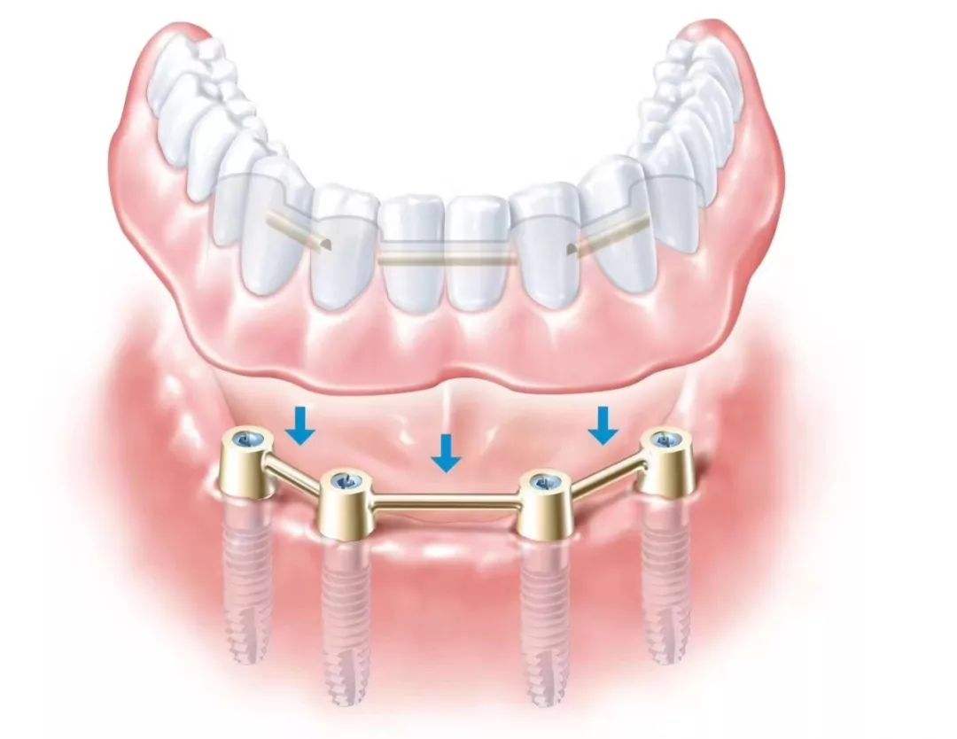 齒缺失後哪種鑲牙方法