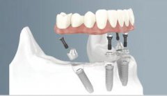 全口缺失，種植牙要做幾顆？牙醫來告訴你