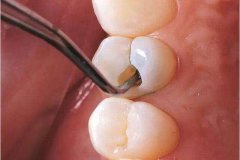 兒童牙科關鍵─乳牙照顧篇