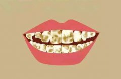 氟斑牙的癥狀，如何防治氟斑牙