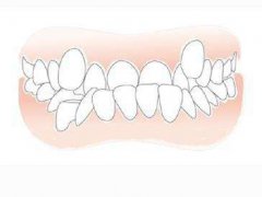 孩子乳牙反頜真的不用管嗎？幾歲矯正才能避免