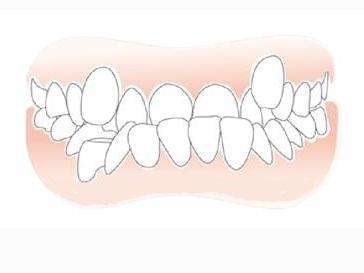 前牙反颌