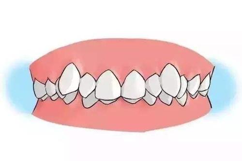 牙齒擁擠影響口腔健康