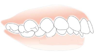 牙齒前突怎麼矯正