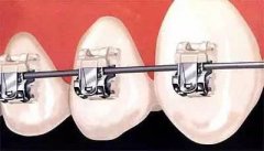 箍牙患者戴上托槽後嘅註意事項
