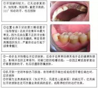 什么样的牙需要拔？牙齿摔断了又该怎么办？