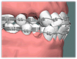 常見的牙齒矯正過程動態圖，一看就懂！