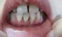 牙齦萎縮真的是不治之症？