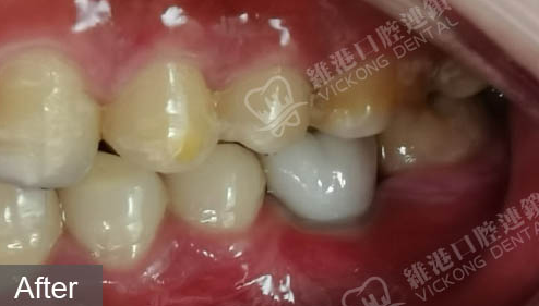 深圳拔牙即種
