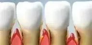 50%的人有“牙齦萎縮”，這些癥狀你有嗎？