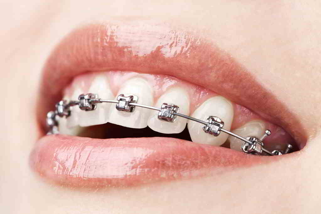 牙齒矯正誤區,深圳牙齒矯正費用