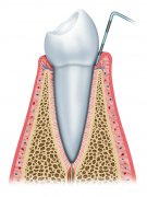 什麼是牙周炎？深圳牙周炎治療費用