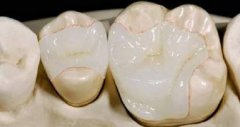 香港牙科專家解析補牙多少錢一顆